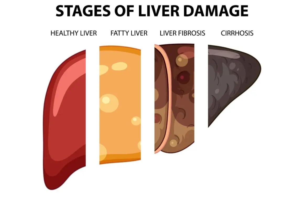Penyakit Liver: Ketahui Gejala, Penyebab, hingga Cara Mengobatinya